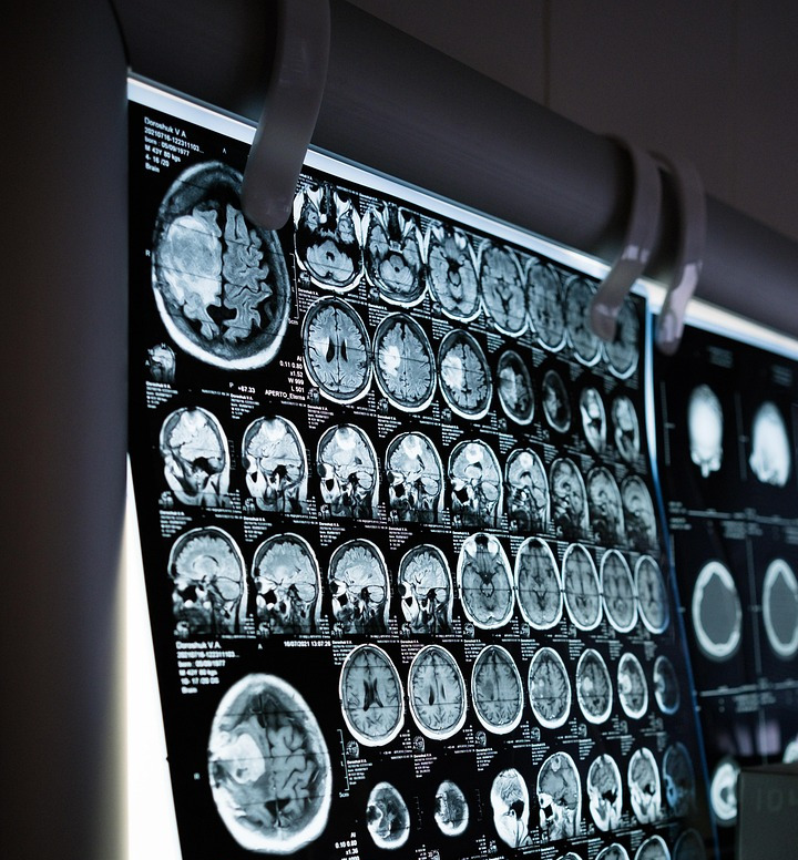 mri brain scan
